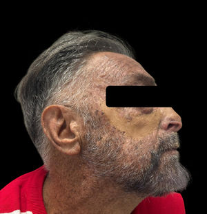 Absence of lesions compatible with basal cell carcinoma after 12 months of treatment with sonidegib in the facial region.