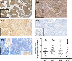 Yap1 expression in nonmelanoma skin cancers. BCC (A), cSCC (B), AFX (C), DFSP (D), and MCC (E) (40×). Histoscore was calculated based on staining intensity using a scale from 0 to 3 (0=no staining, 1=weak staining, 2=moderate staining, 3=strong staining). Statistical significance was evaluated using the Kruskal–Wallis test followed by Dunn multiple-comparison test (*P<.05; **P<.01).