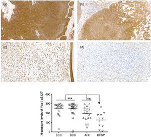 Expression of phosphorylated Yap1 in nonmelanoma skin cancers. Immunostaining for Yap1-pS127 in BCC (A), cSCC (B), AFX (C), and DFSP (D) (40×). Quantification was performed using a histoscore (Hscore) that considers staining intensity and percentage of positive cells, according to the formula: Hscore=1×(% weak staining)+2×(% moderate staining)+3×(% strong staining). The Hscore ranges from 0 to 300. Statistical significance was evaluated using the Kruskal–Wallis test followed by Dunn multiple-comparison test (***P<.001; ns, not significant).
