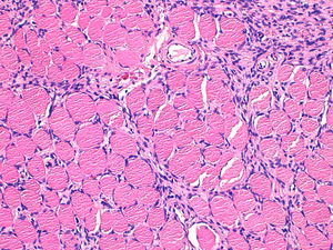 High-power view of a dermatofibrosarcoma protuberans densely infiltrating muscular tissue.