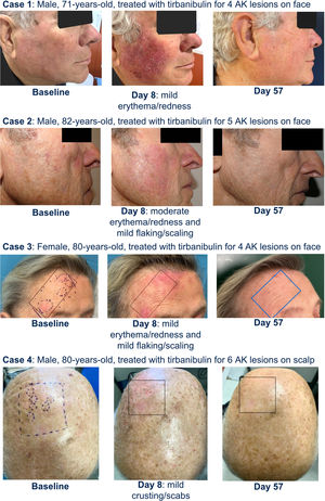 Clinical clearance at day 8 and day 57 in four cases from the treated sample. AKs, actinic keratoses.
