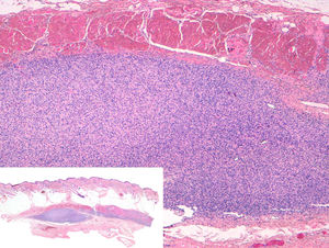 Histologic appearance of subcutaneous dermatofibrosarcoma protuberans, completely located within the subcutaneous tissue without dermal involvement. The fascia and muscle are densely infiltrated by the tumor.