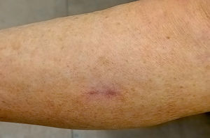 Excellent results following use of a cold scalpel (global OSAS 2.30). Appearance of the scar 3 months after surgery.