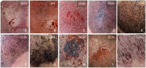Characteristics of necrosis: sequential images of the development process with percentages of occurrence of the different findings. (A) White area after anesthesia/tumescence (intraoperative). (B) Purplish area after incisions (intraoperative). (C) Area of intense reactive bleeding (intraoperative). (D) Blackish skin area (88.9% 24h after the procedure). (E) Perifollicular purulent exudate (75% 48h after the procedure). (F) Interfollicular serous exudate (58.3% 48h after the procedure). (G) Thick protruding crust (51.9% 72h after the procedure). (H) Sunken blackish eschar (50% more than 96h after the procedure). (I) Erosion after crust removal (mean onset 11±3 days). (J) Pseudotufts.