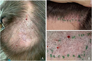 Sequelae of necrosis after resolution. (A) Whitish, atrophic, and sunken skin observed in 52.8% of cases. (B) Whitish fibrous reticulated network with and without shaving observed in 80% of cases.