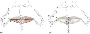 (a) After completing the procedure bilaterally, layered closure is performed at the midline; the flap covering the defect generated by medial rotation of the inferior flap is sutured. (b) The mucosal flap is sutured onto the newly created vermilion area, and the borders of the new vermilion of the lower lip are sutured as well.