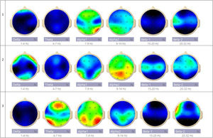Topographic EEG maps of bioelectrical activity across frequency bands. In each row, the maps are displayed from left to right for Delta (1-4 Hz), Theta (4-7 Hz), Alpha-1 (7-9 Hz), Alpha-2 (9-14 Hz), Beta-1 (15-20 Hz), and Beta-2 (20-32 Hz).