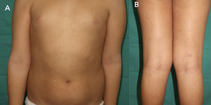 Cutaneous lesions consisting of erythematous-brown macules affecting the trunk and upper (A) and lower (B) extremities.