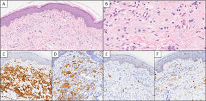 (A) Initial skin biopsy showing an infiltrate in the superficial and mid dermis composed of histiocyte-like cells (H&E, 200×). (B) At higher magnification, cells exhibit foamy cytoplasm with a rounded nucleus and occasional multinucleation (H&E, 600×). These cells are positive for CD163 (C, 200×) and CD68 (D, 200×), and negative for S100 (E, 200×) and CD1a (F, 200×).