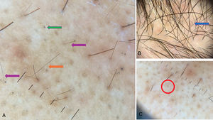 (A) Exclamation mark hairs (purple arrows), Pohl-Pinkus constriction (orange arrow), black dots (green arrow). (B) Circular hair (blue arrow). (C) Broken hair (red circle).