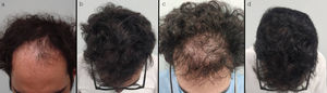 Patient #1: (a) advanced androgenetic alopecia before hair transplantation; (b) 12 months after hair transplantation; (c) anagen effluvium 3 weeks after dutasteride mesotherapy; (d) resolved effluvium 4 months after the episode.
