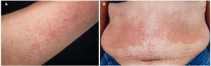 Purpuric patches and petechiae on the inner region of the arms (A), abdomen, and flanks (B).