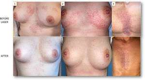 Clinical progression before and after laser treatment. (1) After 6 sessions: excellent response; currently on maintenance therapy every 6 months. (2) Very good response, no skin lesions after 5 laser sessions. (3) Remarkable improvement after a single session.