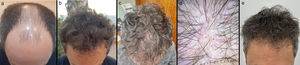 Patient #2: (a) advanced androgenetic alopecia before hair transplantation; (b) 10 months after hair transplantation; (c) anagen effluvium 4 weeks after dutasteride mesotherapy; (d) trichoscopic image showing generally poor density with multiple regrowing vellus hairs (red dots) and isolated dystrophic hairs (green dot); (e) resolved effluvium after 3 months.