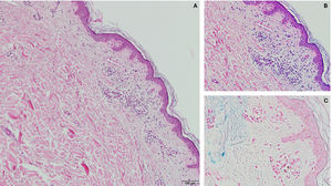 Histopathological study. Hematoxylin–eosin 10× (A). Hematoxylin–eosin 40× (B). Perls stain (C).