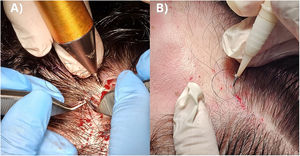 LH-FUE extraction and implantation process. (A) LH-FUE extraction using the WAW Duo system (Devroye Instruments®). (B) Implantation of long-hair follicular units using an implanter.