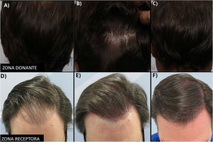 LH-FUE results. (A) Donor area before surgery. (B) Donor area in the immediate postoperative period. (C) Donor area 24h after surgery. (D) Recipient area before surgery. (E) Recipient area in the immediate postoperative period. (F) Recipient area 6 months after surgery.