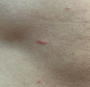Scabies. Burrow drawn by the mite Sarcoptes scabiei as it moves through the epidermis. When lesions appeared on the hands, pruritus forced scratching, which in writings of the period was euphemistically called “playing the guitar.”.