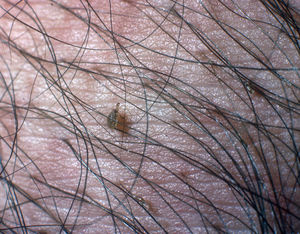Pediculosis pubis. Phthiriasis, or pediculosis of the pubis, is caused by Pthirus pubis, also known as the crab louse or pubic louse. The image shows a crab louse and numerous cerulean macules, small grayish-brown spots caused by the anticoagulant activity of the lice while feeding, which produce small hemorrhages under the skin.