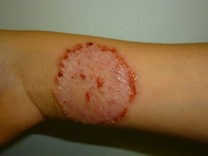Tinea corporis. Tinea is an infection caused by dermatophyte fungi, named according to the body area affected. The image shows tinea of the body, with the typical rounded circular lesion and an actively growing border. Today, effective antifungal treatments usually allow cure.