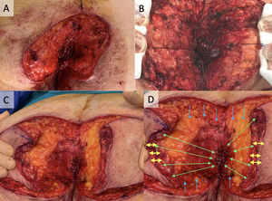 Detail of the endoanal reconstruction. Detail of the endoanal reconstruction, corresponding to the junction between the anal mucosa and the bilateral flap. The endoanal defect was sutured to the fatty region, corresponding to the deep region of the flap (green arrows in Panel D). Subsequently, the epidermis of both flaps was sutured, except in the central region, allowing creation of a new anal canal. Finally, the cranial and caudal margins of the defect were approximated to the endoanal region and sutured to the upper and lower skin regions (blue arrows in Panel D). Panel B shows the everted endoanal mucosa. In the anal canal area, to maintain the orifice, the skin mucosa, which would become the new mucosa, was inverted (yellow arrows in Panel D). Externalization of the endoanal mucosa produced sensory discomfort typical of mucosal externalization.