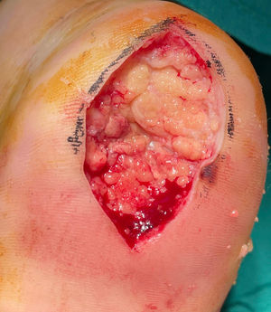 “1st surgical stage”. A 5×2.5-cm defect on the left heel after surgical extension for acral melanoma in situ.