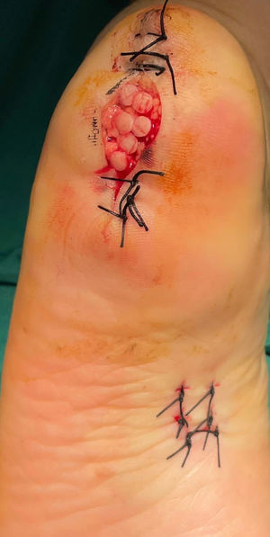 “2nd surgical stage”. Primary closure of both edges of the lozenge-shaped defect. Six micrografts obtained with a No. 4 punch were applied to the central area of the defect.