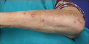 Clinical image. Ulcerative papulonodular lesions on the left forearm, with a sporotrichoid pattern.