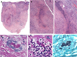 (A–C) Granulomatous folliculitis with necrosis, central suppuration, and Langhans-type multinucleated giant cells (C) (H&E). (D–F) Morula-like organisms—sporangia—revealed by PAS (D and E) and Grocott (F) stains, both intracellularly (D and F) and in abscessed areas (E).