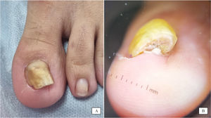 (A) Onycholysis and deviated nail plate. (B) Frontal-view dermoscopy: increased distal transverse axis with folding of the nail plate on the outer side, onychauxis, and subungual hyperkeratosis.