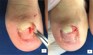 (A) Nail bed after removal of the distal portion of the nail plate and hyperkeratosis. The forceps hold a fragment that is very adherent to the lateral fold and nail bed, causing its depression. (B) After removal of the lateral nail-plate fragment, the nail bed and a rectangle of healthy nail remain, which will serve as a guide for growth of the new nail plate.