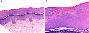 The sections show acral skin with a collection of intracorneal hematic material. The epidermis is of normal thickness, with no alterations in the dermis.