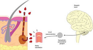 Anatomical arrangement at the level of the sweat gland, with blood vessels organized in a network. Under stress conditions, sympathetic activation occurs with an alpha-1 receptor response; pressure is generated and the vessels close to the gland contract, subsequently dilating and rupturing. The extravasated blood is propelled, together with sweat, toward the epidermis.