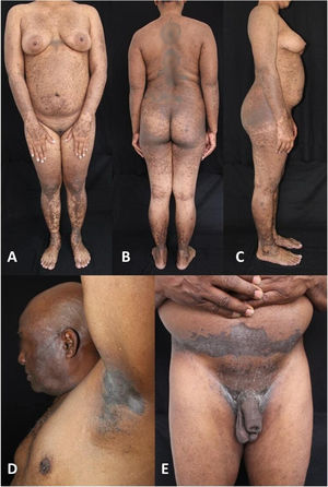 (A–C) Patient 1: multiple brown macules, papules and plaques scattered all over the body of a female phototype IV patient. (D and E) Patient 2: multiple dark brown and black macules, papules and plaques over axillae, hypogastrium and inguinal folds of a male phototype VI patient.