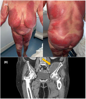 Case 1. (A) Psoriatic erythroderma. (B) CT scan shows an abscess in the iliac muscle.