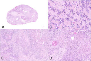 Hematoxilina-eosina. A) Foto macromicro. B) Componente mesenquimal de osteosarcoma. C) Áreas de transición entre los componentes osteoide y escamoso. D) Componente epitelial de carcinoma escamoso.