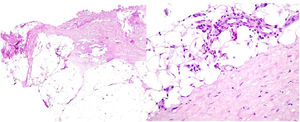 A y B. H-E (2×, 20×). Fascitis eosinofílica. A. Gruesas bandas de esclerosis en la hipodermis. B. Presencia de eosinófilos en el tejido celular subcutáneo y la hipodermis.