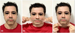 Patient's facial evaluation of rest position (a), lateral skin extensibility (b) and anterior skin extensibility (c) showing hypermobility and intense skin laxity.