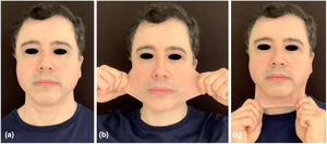Patient's facial evaluation 180 days after the first treatment protocol – two sessions of full-face treatment with a monthly interval in 2019. Rest position (a), lateral skin extensibility (b) and anterior skin extensibility (c) exhibiting a significant collagen stimulus with improvement of skin contouring and tightening.