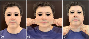 Patient's facial evaluation 180 days after the second treatment protocol – two sessions of full-face treatment with a monthly interval in 2021. Rest position (a), lateral skin extensibility (b) and anterior skin extensibility (c) presenting increased skin thickness and resistance.
