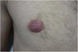 Aréola mamaria derecha eritemato-violácea, engrosada e infiltrada al tacto.