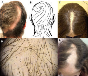 Linear alopecia areata. (A) Linear alopecic patch extending from the vertex to the left occipital area, following Blashko's lines. (B) Blashko's lines on the head. (C) Linear alopecic patch along the interparietal area. (D) Trichoscopy shows black dots, pigtail hairs and exclamation mark hairs (FotoFinder® medicam 1000, Fotofinder systems, Germany). (E) Linear alopecic patch on the frontal and left parietal area.