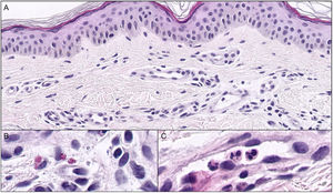 Histopatología de la pápula urticariforme. Aumento de la vascularización en dermis superficial (A, hematoxilina/eosina ×20). Eosinófilos (B, Hematoxilina/eosina ×60) y neutrófilos intravasculares (C, hematoxilina/eosina ×60).