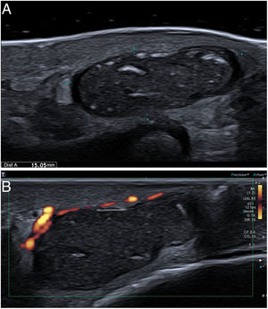 High resolution ultrasound of the posterior aspect of the elbow. Well-defined, predominantly cystic, 15-mm lesion. It is anechoic in the periphery with heterogeneous content and internal focal echoic areas suggestive of keratin (A). Lesion appears avascular, without evident internal vessels (B).