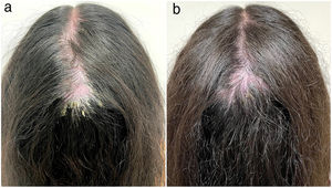 (a) A large patch of cicatricial alopecia on the vertex and crown, extending to left and right parietal scalp; intense erythema, adherent scales, yellow/hemorrhagic crusts, pustules and polytrichia. (b) Satisfactory improvement after therapeutical approach: reduction of erythema, pustules and scales, hair growth, and no progression of alopecia.