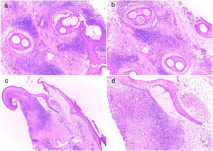 Histopathological study: (a, b) Vertical section showing absence of sebaceous glands, interstitial lymphoplasmacytic infiltrates, scarce neutrophils, plasma cells dermal aggregates, perifollicular concentric fibrosis, and granulomas around fragmented hair shafts (hematoxylin–eosin stain; ×100). (c) Horizontal section showing hyperkeratosis, perifollicular and interstitial lymphoplasmacytic infiltrates, scarce neutrophils, and a granuloma around the hair follicle (hematoxylin–eosin stain; ×40). (d) Horizontal section showing perifollicular and interstitial lymphoplasmacytic infiltrates, scarce neutrophils, and a granuloma around the hair follicle (hematoxylin–eosin stain, ×100).