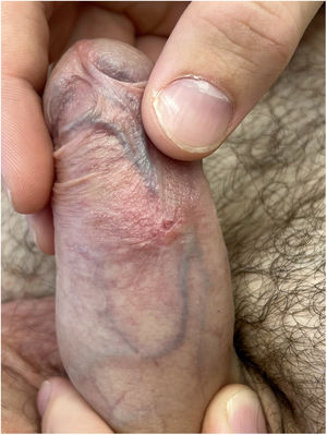 Patient's scar on the penis’ ventral surface.