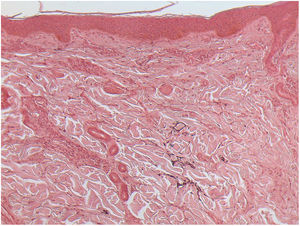 Nearly complete loss of elastic fibers in the layers of the papillary and reticular dermis (Orcein stain, 100×).