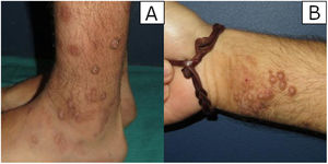 Imágenes clínicas representativas de lesiones localizadas en tobillo izquierdo («A») y antebrazo derecho («B»).