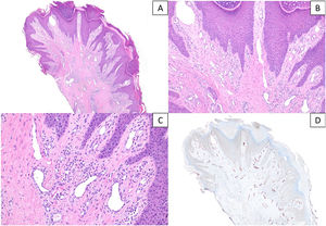 A y B) Secciones histológicas que muestran cambios epidérmicos de prurigo nodular/liquen simple crónico con una proliferación vascular prominente en dermis superficial, asociada a un infiltrado inflamatorio linfocitario leve-moderado (hematoxilina & eosina, x40 y x100). C) Detalle a mayor aumento de la proliferación vascular constituida en su mayor parte por capilares, sin signos de atipia en el endotelio (hematoxilina & eosina, x200). D) Tinción inmunohistoquímica frente a D2-40 (podoplanina) que realza el incremento moderado de vasos linfáticos, con ocasionales dilataciones (x40).